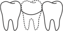 a line drawing showing a jaw bone with a missing tooth in need of bone grafting